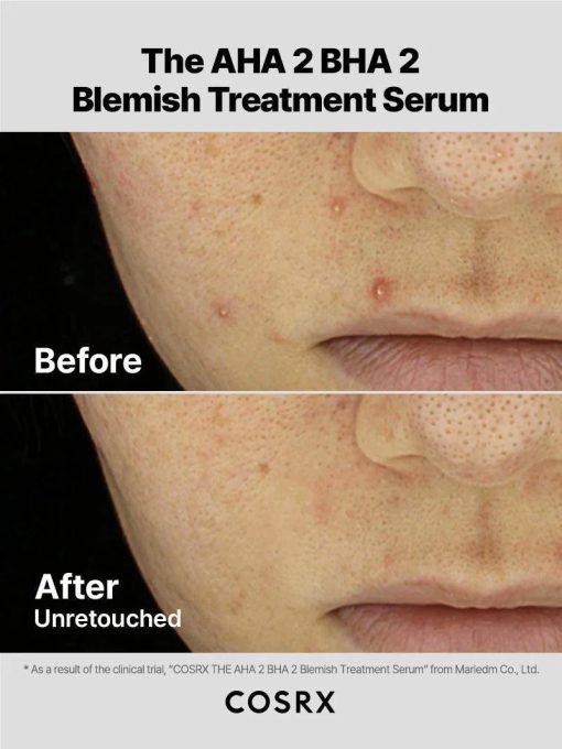 The AHA 2 BHA 2 Blemish Treatment - Imagen 3